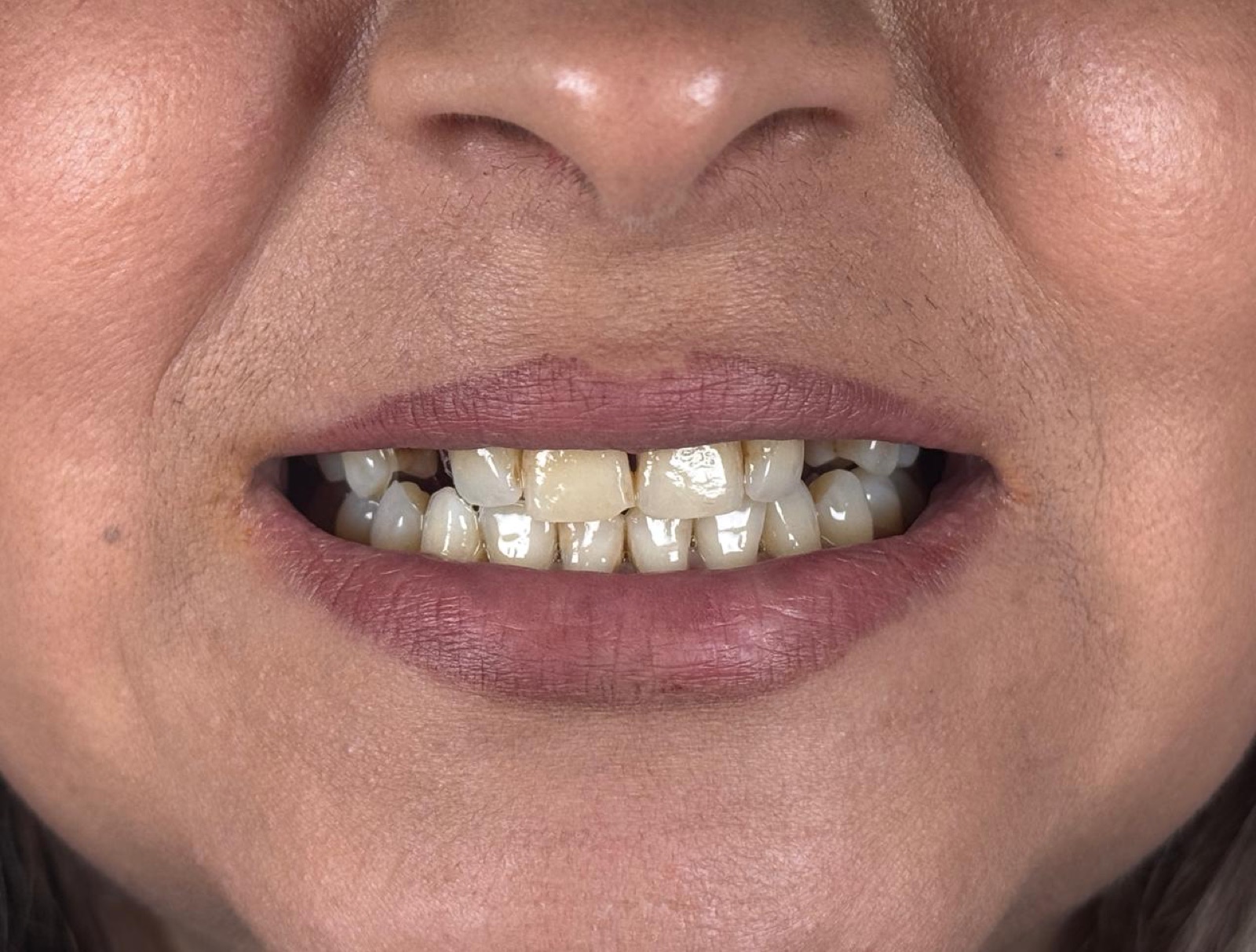 Para — Faseta porcelani